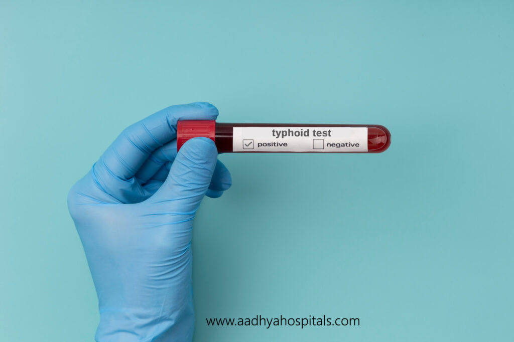 typhoid test